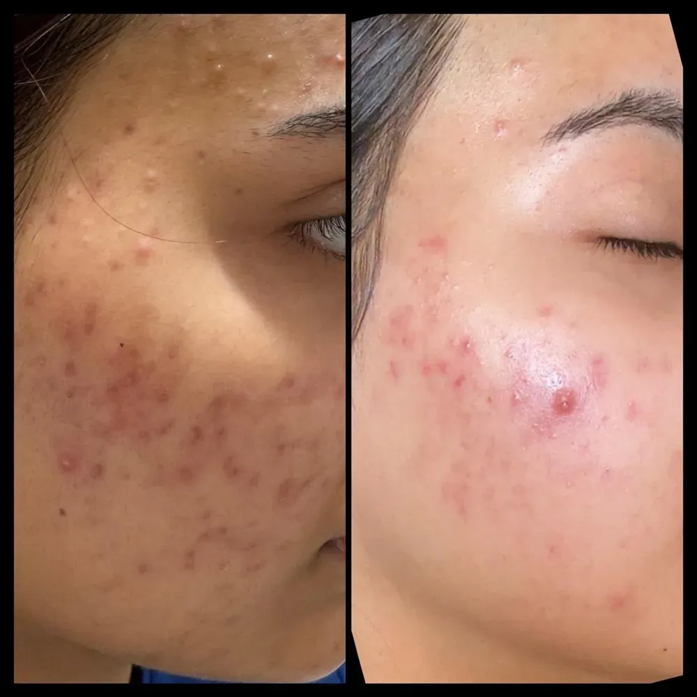Envi Aesthetics acne treatment before and after