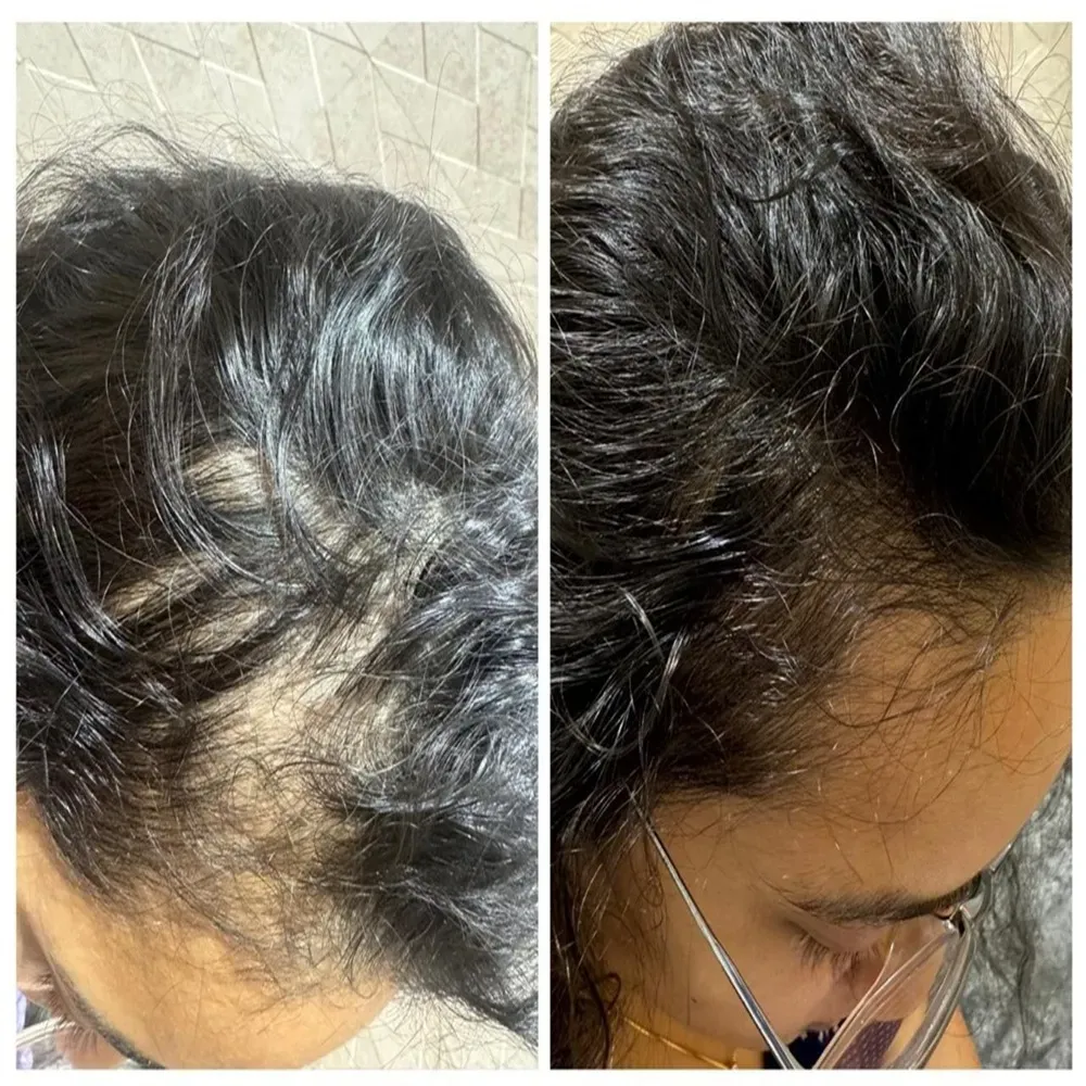 Envi Aesthetics hair regrowth before and after