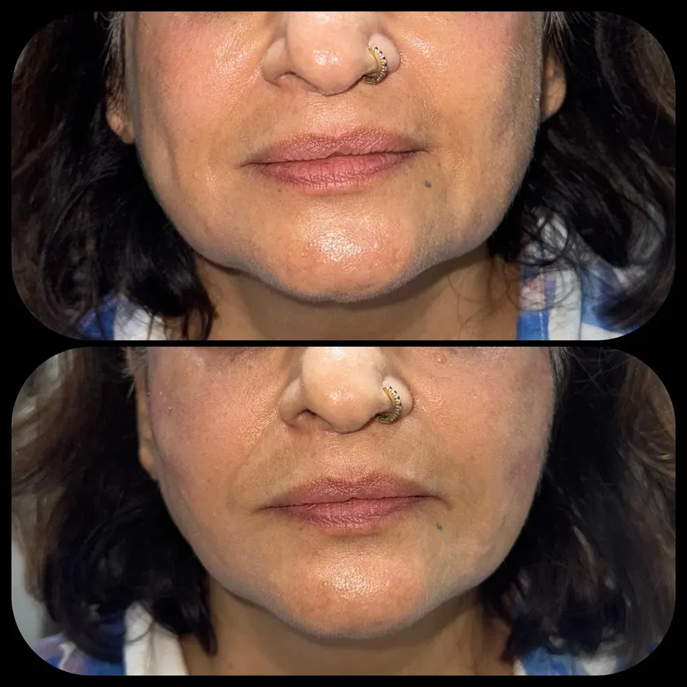 Envi Aesthetics skin rejuvenation before and after