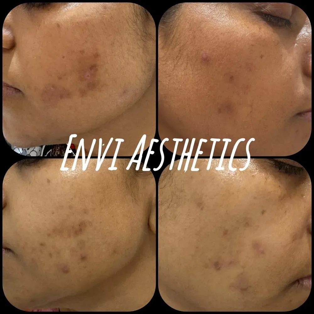 Envi Aesthetics skin treatment before and after