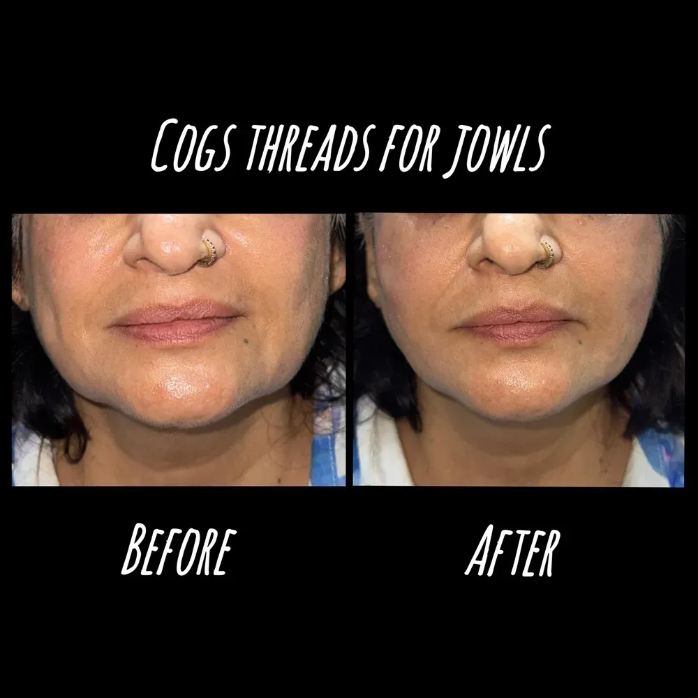 Envi Aesthetics treatment result before and after