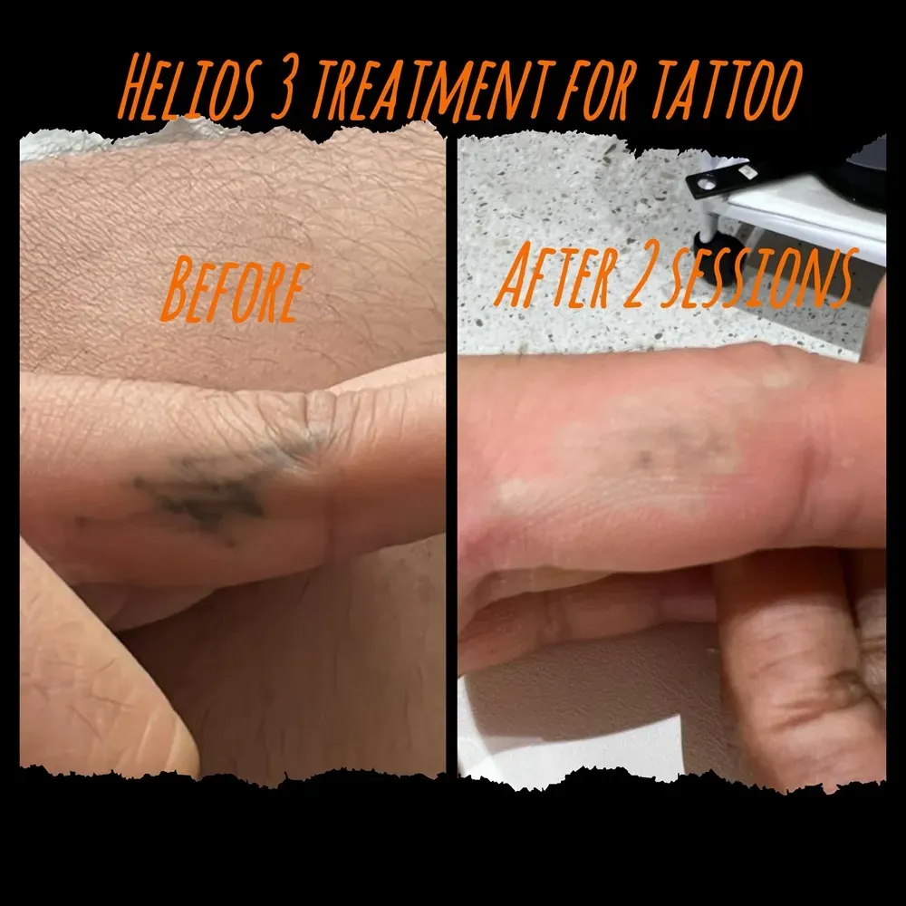 Envi Aesthetics treatment result before and after
