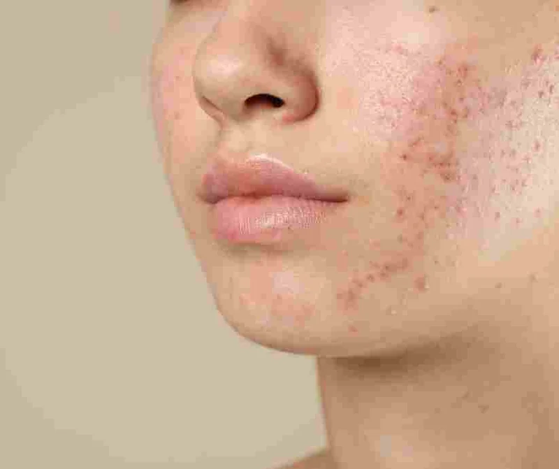 Acne Scar Removal